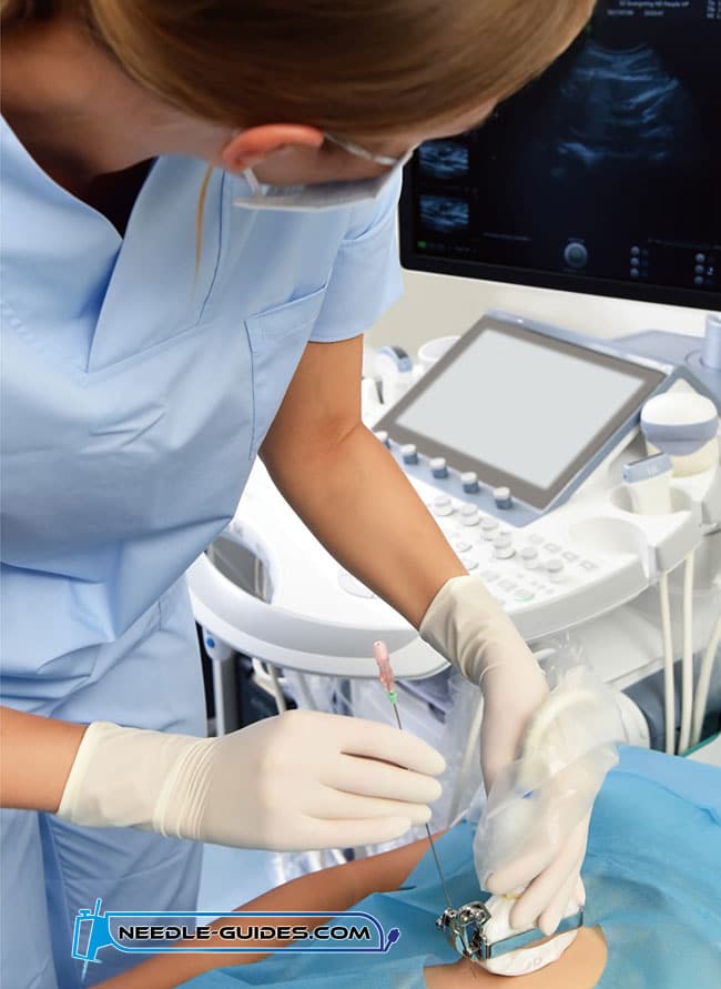 Philips ultrasound needle guide mounted on probe